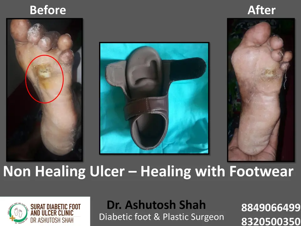 Diabetic Foot  PPT 3 checked by sir.pptx-68.webp